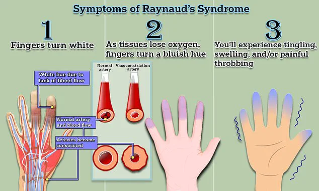 Exclusive Insights: Scientists Identify Potential Breakthrough in Raynaud's Disease Treatment