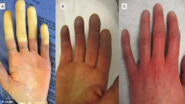 Exclusive Insights: Scientists Identify Potential Breakthrough in Raynaud's Disease Treatment