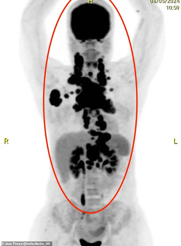 24-Year-Old Brazilian Mother Diagnosed with Rare Aggressive B-Cell Non-Hodgkin Lymphoma After Unexplained Weight Loss