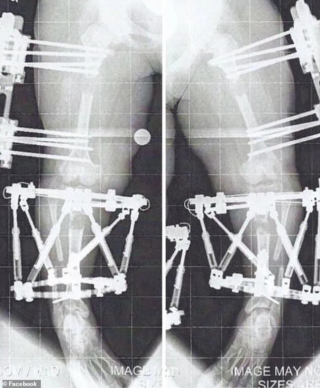The Controversy of Limb Lengthening Surgery: Medical Innovation and the Human Cost
