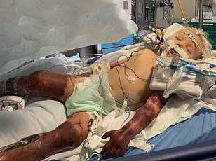 Australian Study Finds Type 2 Diabetes Doubles Sepsis Hospitalization Risk