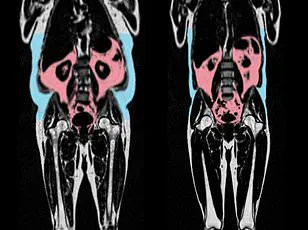 New Study Reveals Underweight May Pose Greater Longevity Risk Than Overweight, Challenging Previous Assumptions