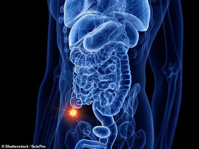 Surge in Appendix Cancer Alarms Experts as Cases Triple in Younger Generations