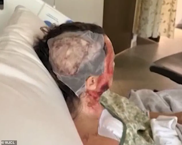 Acid Attack Leaves Woman Disfigured and Facing Medical Bills in Savannah, Georgia
