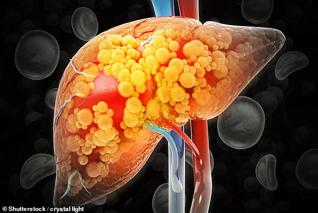 Breakthrough in Fight Against Rapidly Spreading Liver Disease: Spanish Study Reveals Potential Cure Using Common Drugs Pemafibrate and Telmisartan