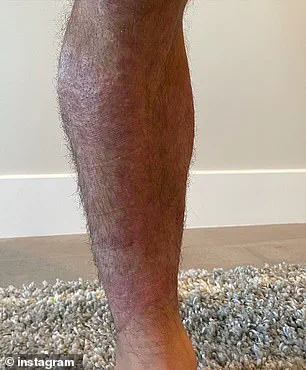 Chad Mendes' Struggle with Treatment-Resistant Plaque Psoriasis Highlights Need for New Approaches