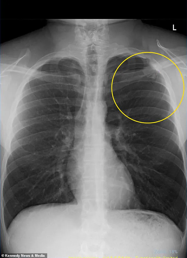 ‘I Thought I Was Invincible’: Young Vaper’s Collapse Highlights Health Risks, as Experts Warn on E-Cigarette Dangers