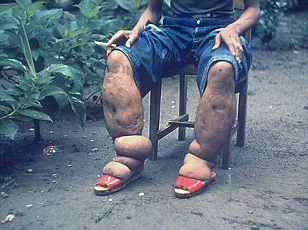 Kissing Bugs Spread Along U.S.-Mexico Border, Heightening Chagas Disease Concerns