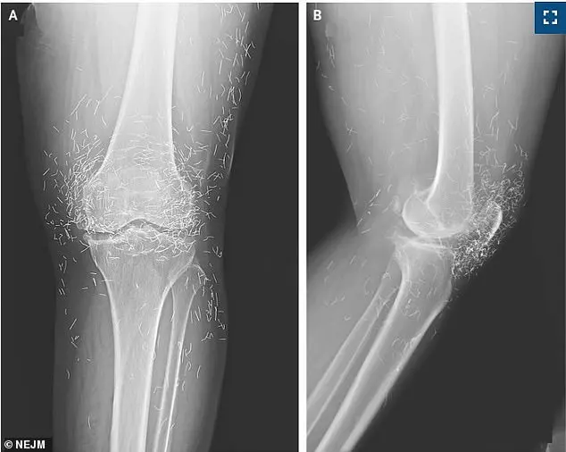 Medical Crisis Sparks Concerns Over Unregulated Alternative Therapies After Woman Found with Gold Threads in Joints