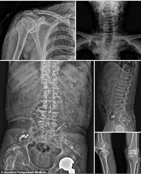 Medical Crisis Sparks Concerns Over Unregulated Alternative Therapies After Woman Found with Gold Threads in Joints