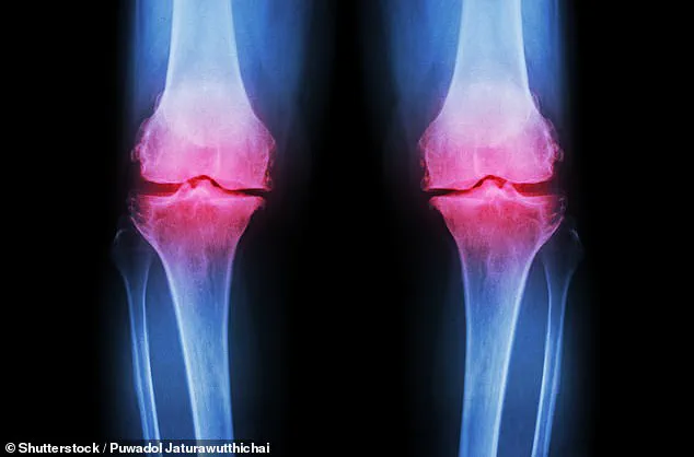 Osteoarthritis: A Global Health Challenge with Growing Consequences