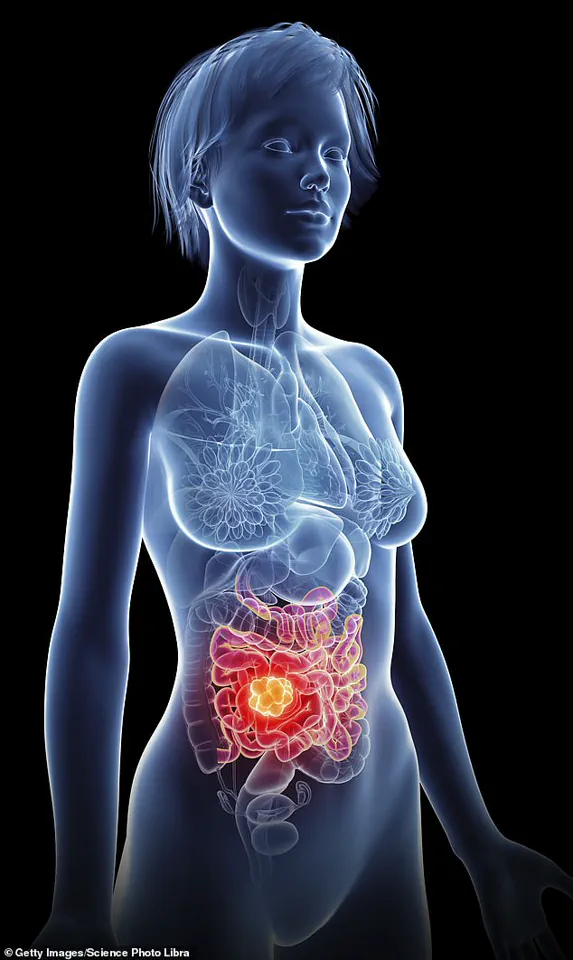 Privileged Access to Expert Insights: Preventing Bowel Cancer Through Lifestyle Changes for Public Well-Being