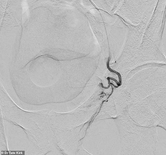 The Silent Crisis: Benign Prostatic Hyperplasia and Its Growing Impact on Men's Health