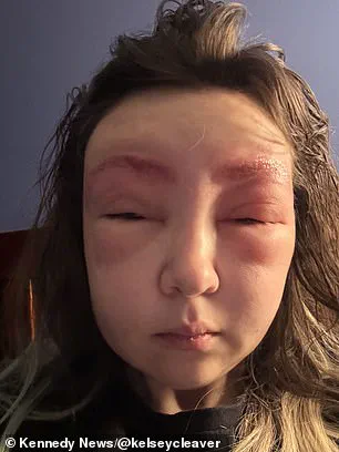 Urgent Warning: Severe Allergic Reaction After Eyebrow Tinting Sparks Safety Concerns