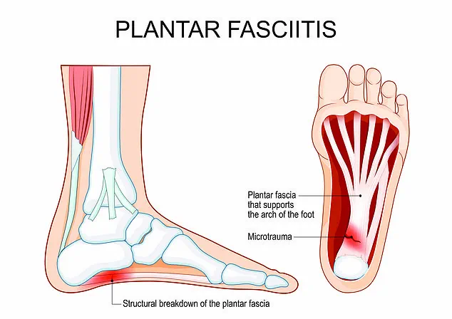 The Silent Epidemic: Plantar Fasciitis and Its Growing Burden on American Communities
