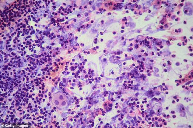 Urgent Update: Third TB Case Confirmed at Archbishop Riordan High School; SF Health Officials Declare Outbreak