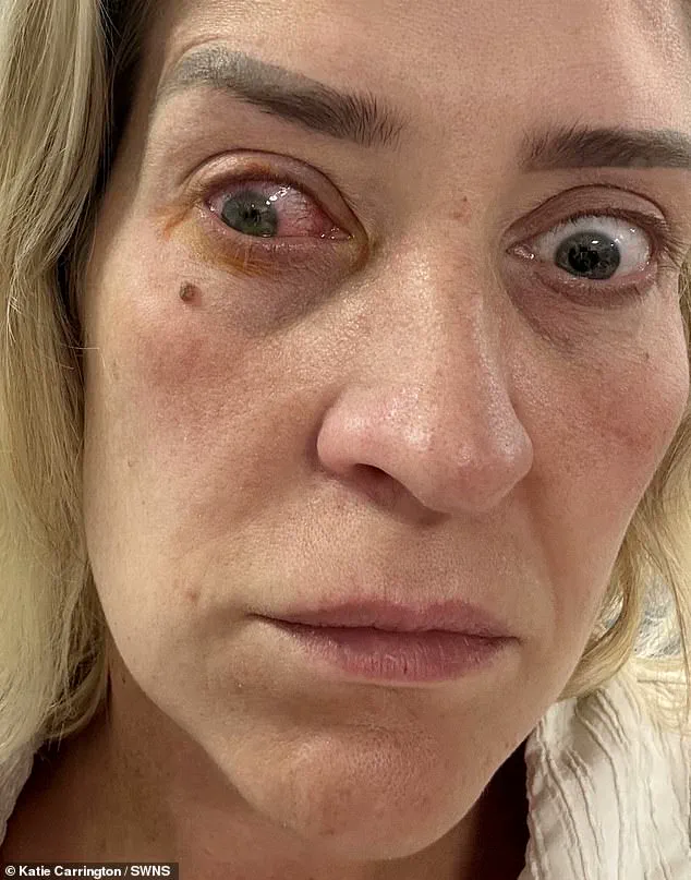 Nurse's Cautionary Tale: How Improper Contact Lens Use Led to Temporary Blindness