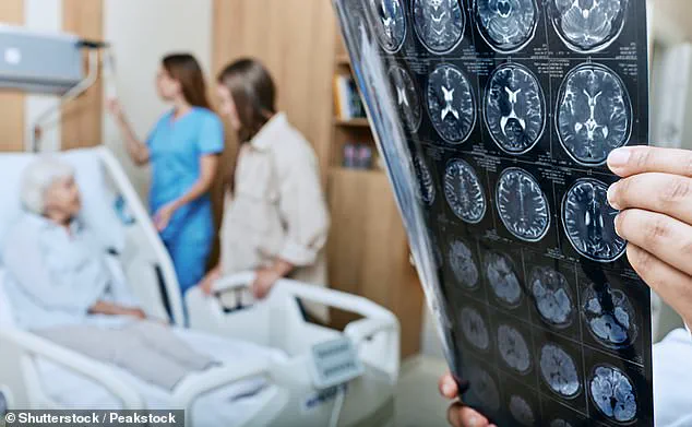 Gut Microbiome and Alzheimer's: Study Shows Microbiota Transfer Triggers Neurodegeneration