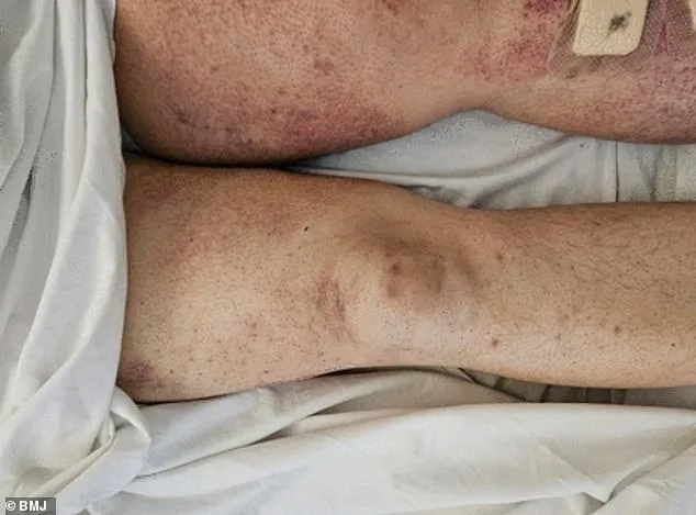 Scurvy's Resurgence in the UK: A Hidden Risk of Weight Loss Injections