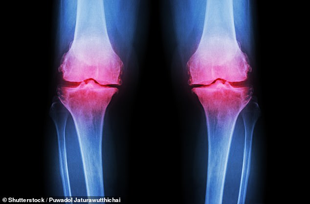 Alarm Bells Ring as Extreme Fitness and Restrictive Diets Drive Surge in Young Adults' Bone Injuries and Early Osteoarthritis