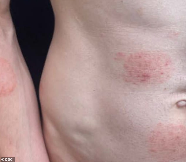 Minnesota Faces Largest Ringworm Outbreak in U.S. History