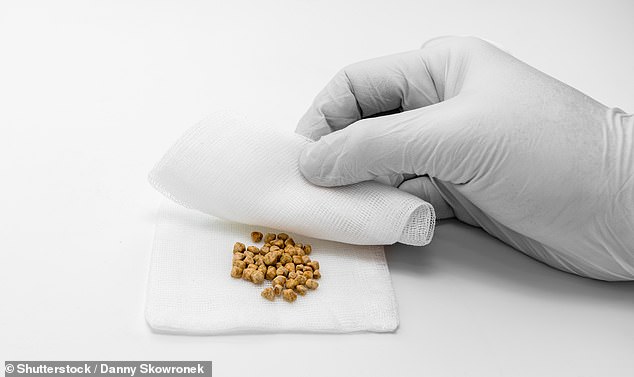 Cheese May Reduce Gallstone Risk by 26%, Contradicting Old Dietary Advice