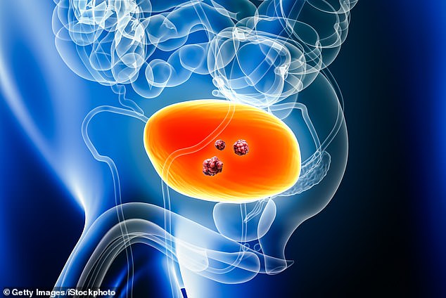 NHS Approves Durvalumab: Immune-Boosting Treatment Halts Progression in Aggressive Bladder Cancer with 32% Risk Reduction