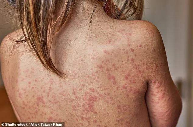 Measles Outbreak in Enfield Schools Sparks Health Warnings Over Low Vaccination Rates
