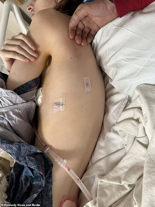 Teenager's Vaping Habit Leads to Life-Threatening Lung Collapse – A Stark Warning