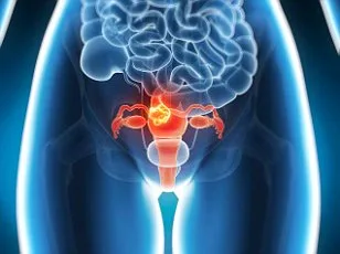 Vulval Cancer Missed for Years: Woman's Journey Through Persistent Pain and Misdiagnosis