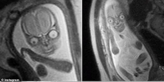 Resurfaced Fetal MRI Images Spark Debate Over Safety During Pregnancy