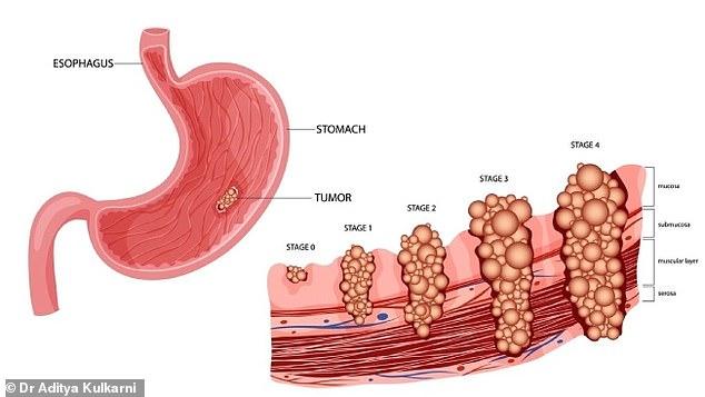 Stomach Cancer Resurgence Alarms Doctors as Cases Rise in Younger Demographics