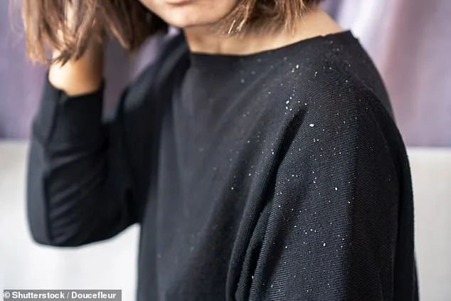 53% Surge in Dandruff-Linked Condition Linked to Microbial Shifts and Aging Populations