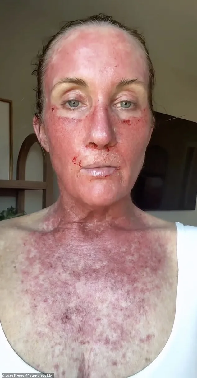 A Mother's Relentless Battle Against Skin Cancer: Kory Feltz's Journey of Survival and Resilience