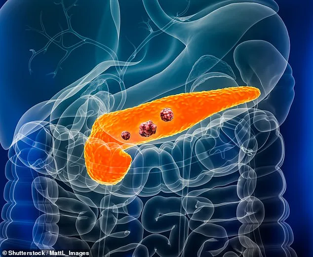 Hebrew University Researchers Uncover Early Warning Signal for Pancreatic Cancer
