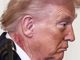 Trump's Red Rash Sparks Health Speculation and Concern
