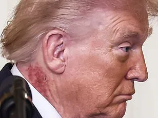 Trump's Red Rash Sparks Health Speculation and Concern