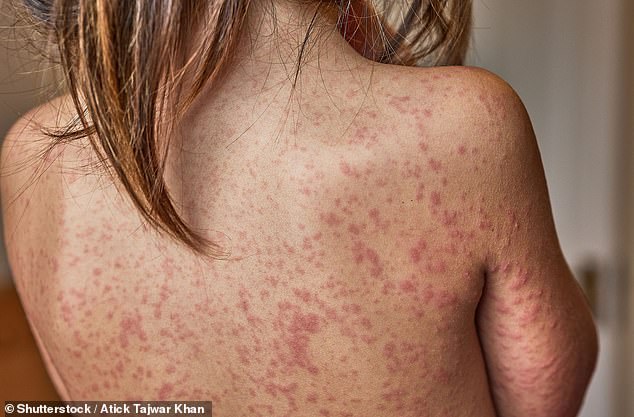 Measles Resurgence in London Sparks Calls for School Bans on Unvaccinated Children