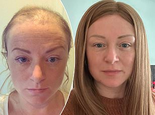 Grey Hair May Signal Cancer Warning, Study Suggests