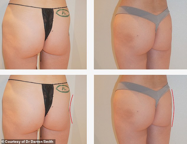 Controversial Cadaver-Derived Filler Alloclae Sparks Debate Over Safety, Efficacy in Plastic Surgery