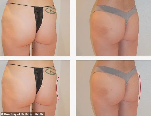 Controversial Cadaver-Derived Filler Alloclae Sparks Debate Over Safety, Efficacy in Plastic Surgery