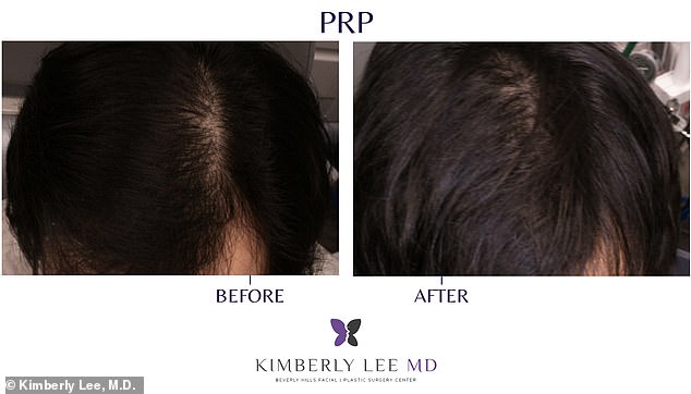 PRP Therapy: The Affordable, Non-Invasive Solution Revolutionizing Hair Loss Treatment