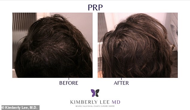 PRP Therapy: The Affordable, Non-Invasive Solution Revolutionizing Hair Loss Treatment