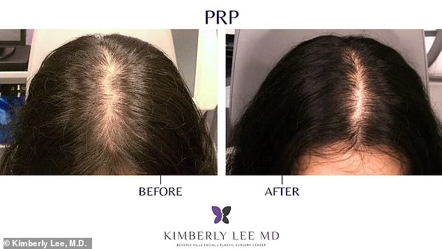 PRP Therapy: The Affordable, Non-Invasive Solution Revolutionizing Hair Loss Treatment