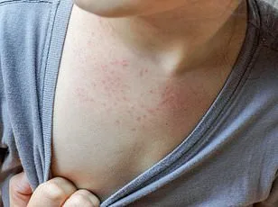 Human Metapneumovirus Surges: CDC Warns of Rising Cases Amid Lack of Vaccine
