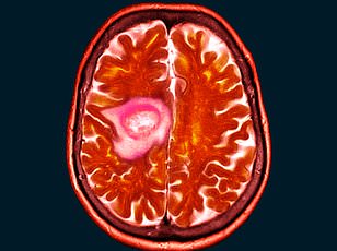 Shelley Whittaker's Journey: From Eye Blur to Brain Tumor Diagnosis