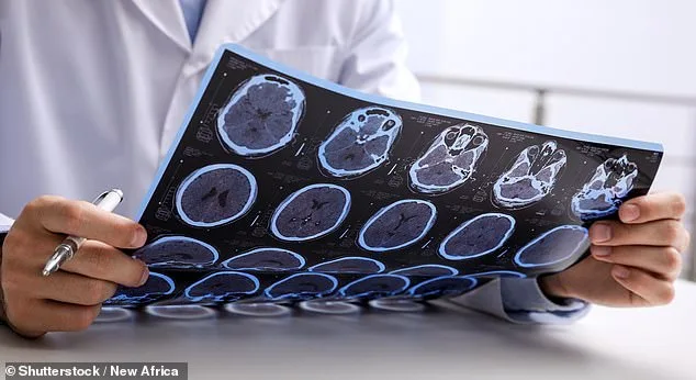 MS Cases in England More Than Double as Study Links Smoking, Obesity, and Deprivation to Higher Mortality