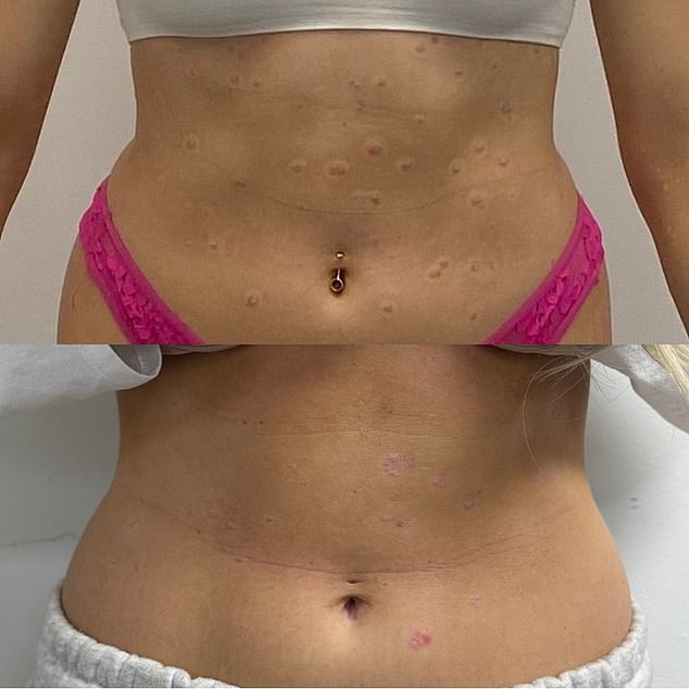 The Hidden Cost of Long-Term Steroid Use in Psoriasis Treatment: A Personal Journey and Systemic Shortcomings