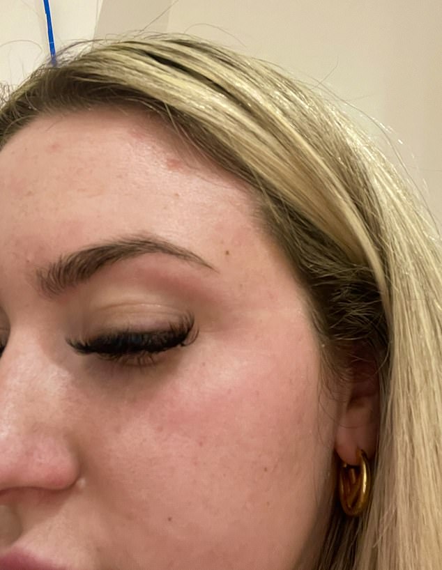 The Hidden Cost of Long-Term Steroid Use in Psoriasis Treatment: A Personal Journey and Systemic Shortcomings