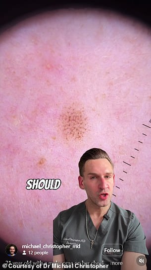 Juliah Thompson, 21, Ignores Mole That Transforms Over Three Months Despite Vigilant Skin Care